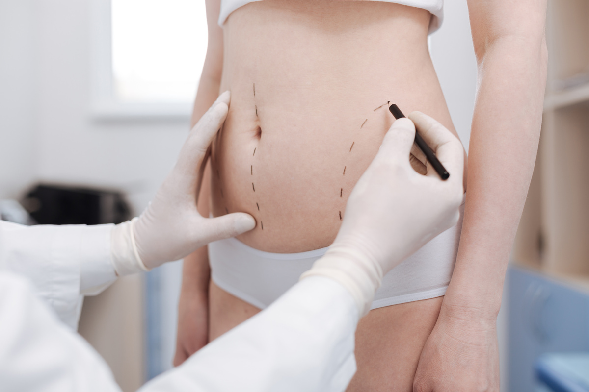 liposuzione come funziona